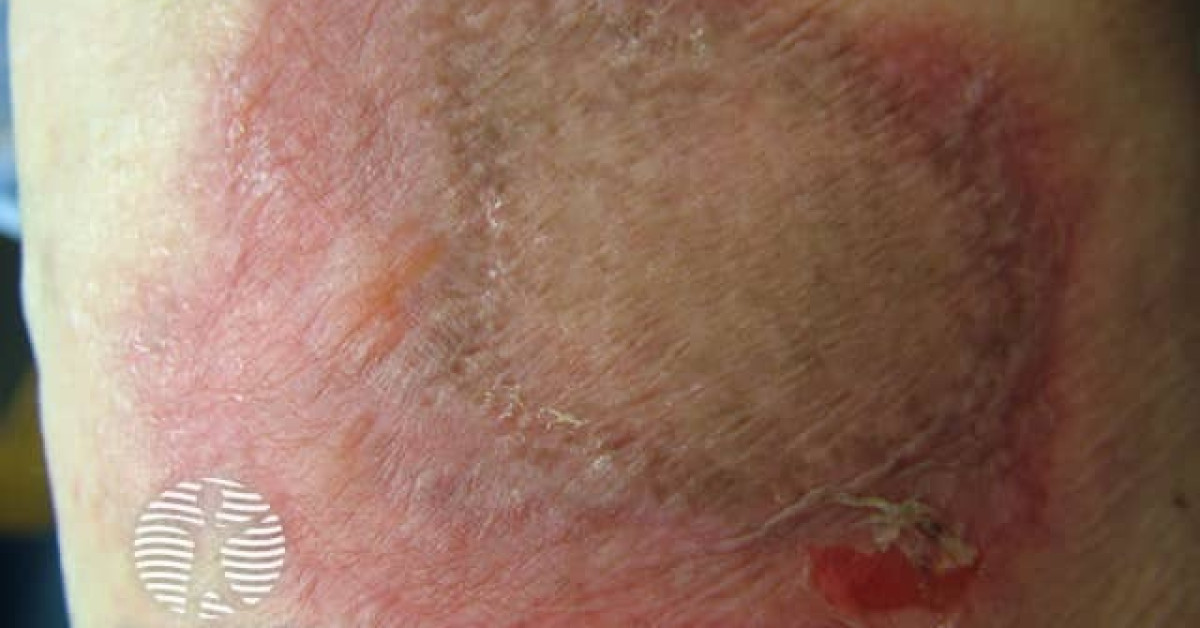 figure 20 blistering image