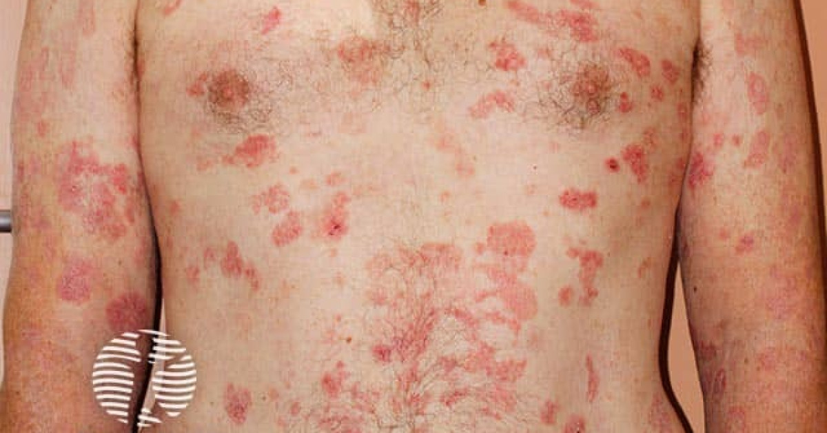 cutaneous t cell lymphoma rash come and go