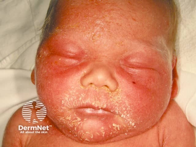 Staphylococcal scalded skin