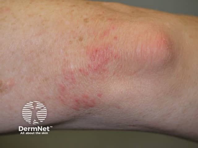 Dermatitis herpetiformis