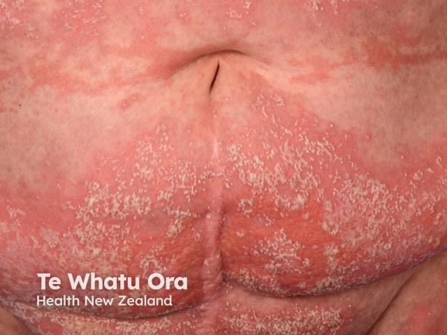 Sheets of pustules coalescing into lakes on the abdomen in generalised pustular psoriasis