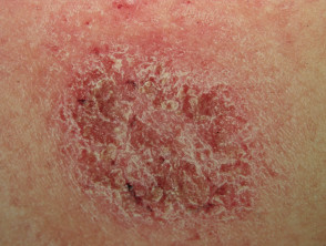 skin blisters that itch