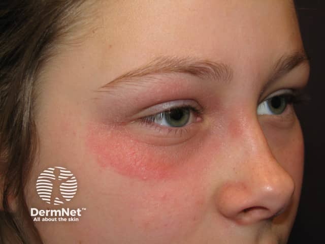 Contact eczema irritant