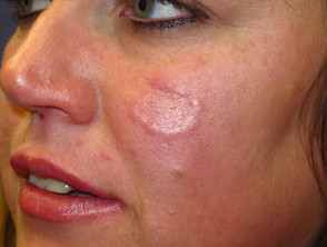 of in adults facial eczema Causes