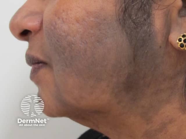 Erythema Dyschromicum Perstans Coexistence Of Erythema Dyschromicum Erythema Dyschromicum Perstans Coexistence Of Erythema Dyschromicum
