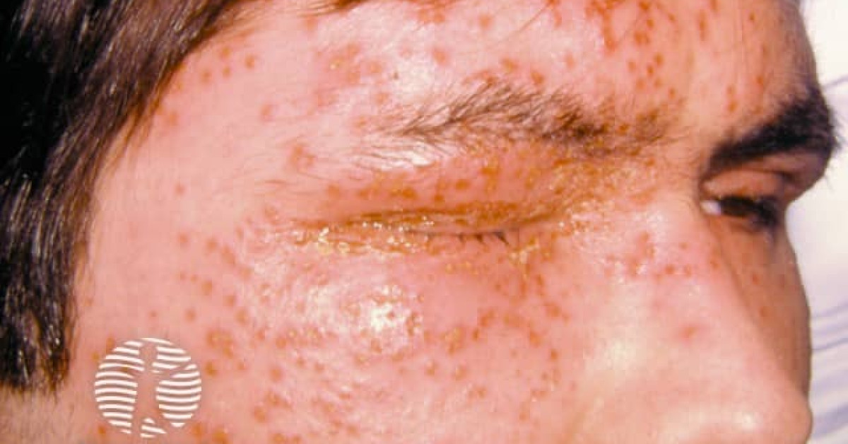 figure 8 blistering image