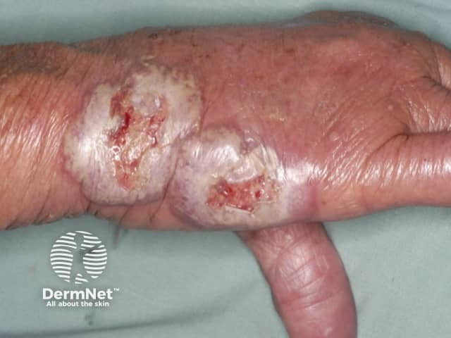 Neutrophilic dermatosis of dorsal hands