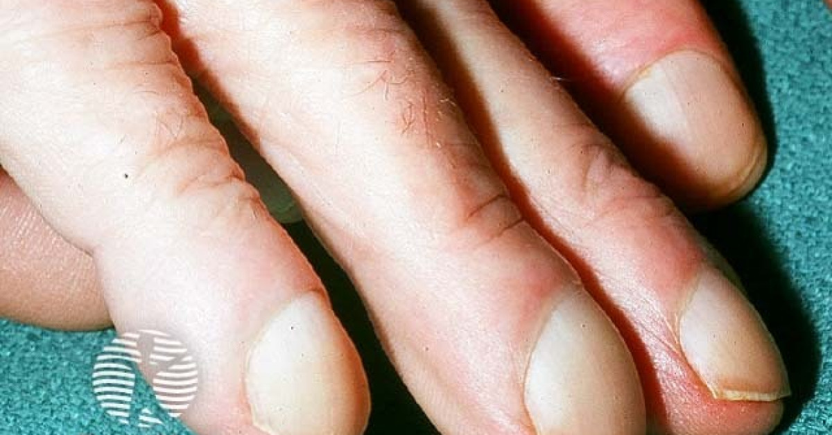 Finger clubbing image