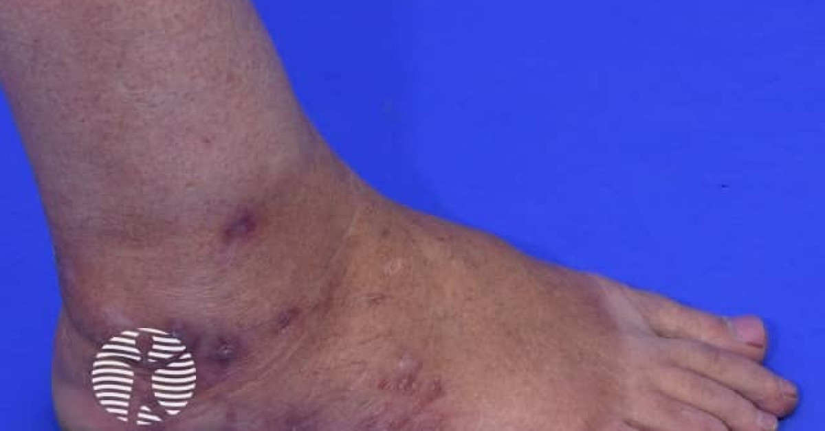 Fish Tank Rash Fishtank granuloma image