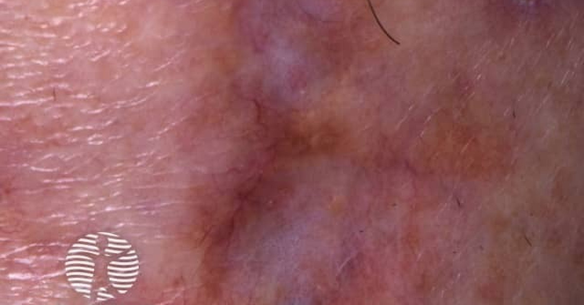 Fish Tank Rash Fishtank granuloma image