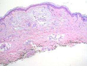 Focal mucinosis figure1