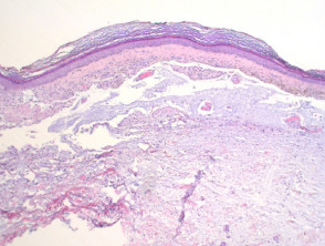 Focal mucinosis figure2