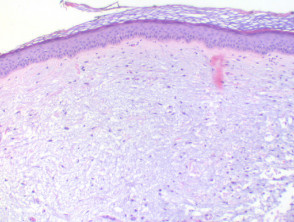 Focal mucinosis figure3