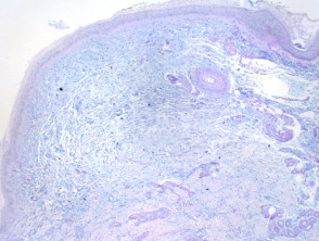 Focal mucinosis figure5
