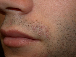 Folliculitis barbae
