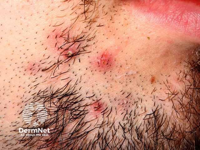 Deeper tender lesions in sycosis barbae
