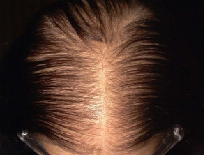 Female pattern hair loss | DermNet