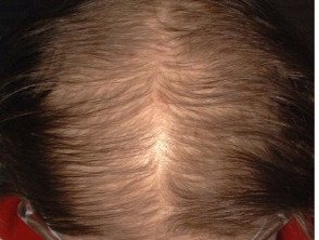 Female pattern hair loss | DermNet