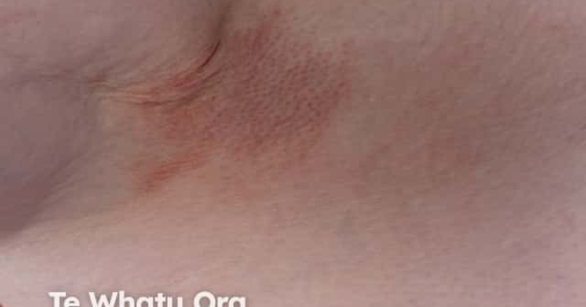 Allergic contact dermatitis to fragrance image