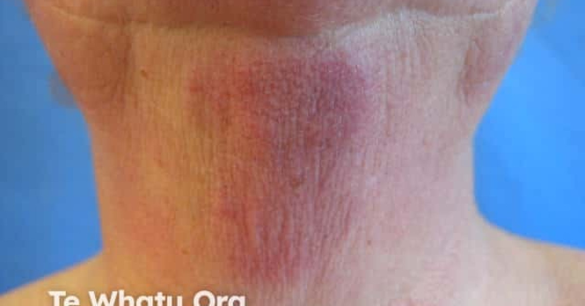 Pefume Rash Allergic contact dermatitis to fragrance image