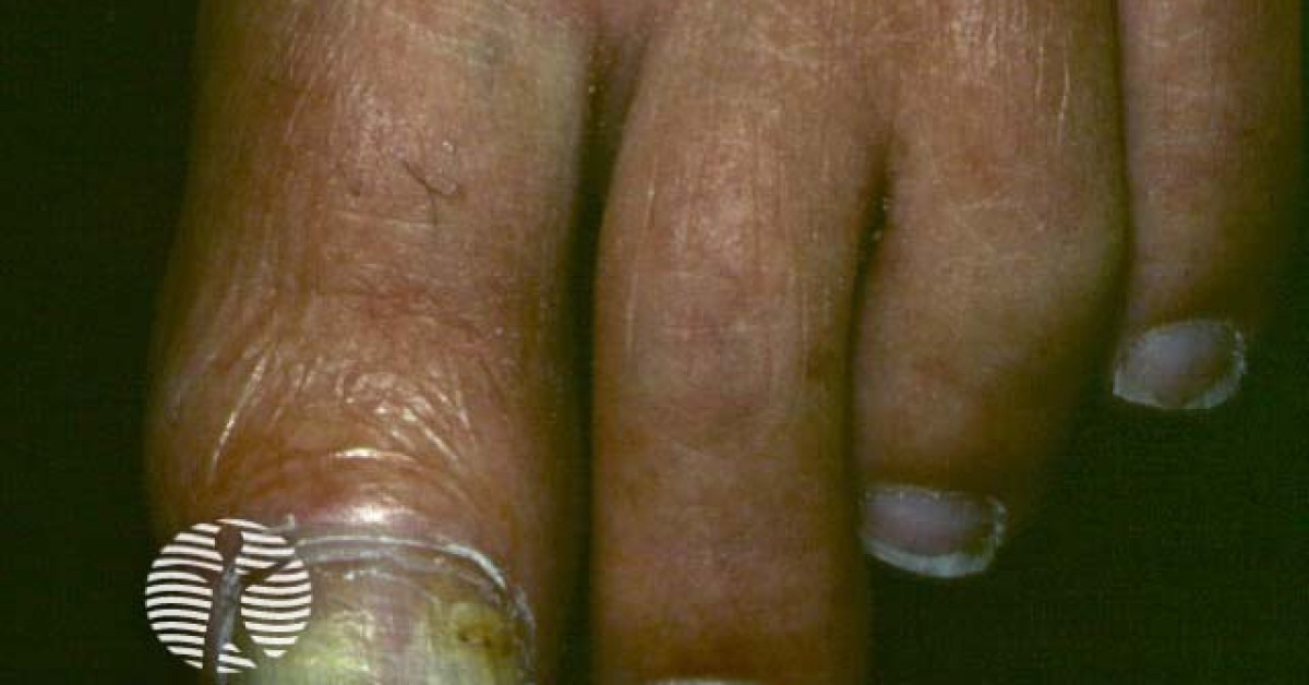 Aspergillus infection image