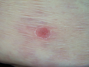 Aspergillus skin lesion