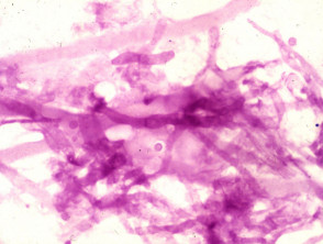 PAS stain of aspergillus seen in a skin biopsy