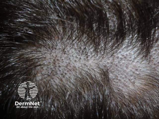 Black dot scalp ringworm