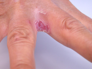 MyMed.com on X: Intertrigo-inflammatory skin rash that occurs due