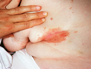 Intertrigo: skin inflammation between breasts - Stock Image - M180/0043 -  Science Photo Library