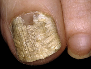 Candida albicans affecting the nail