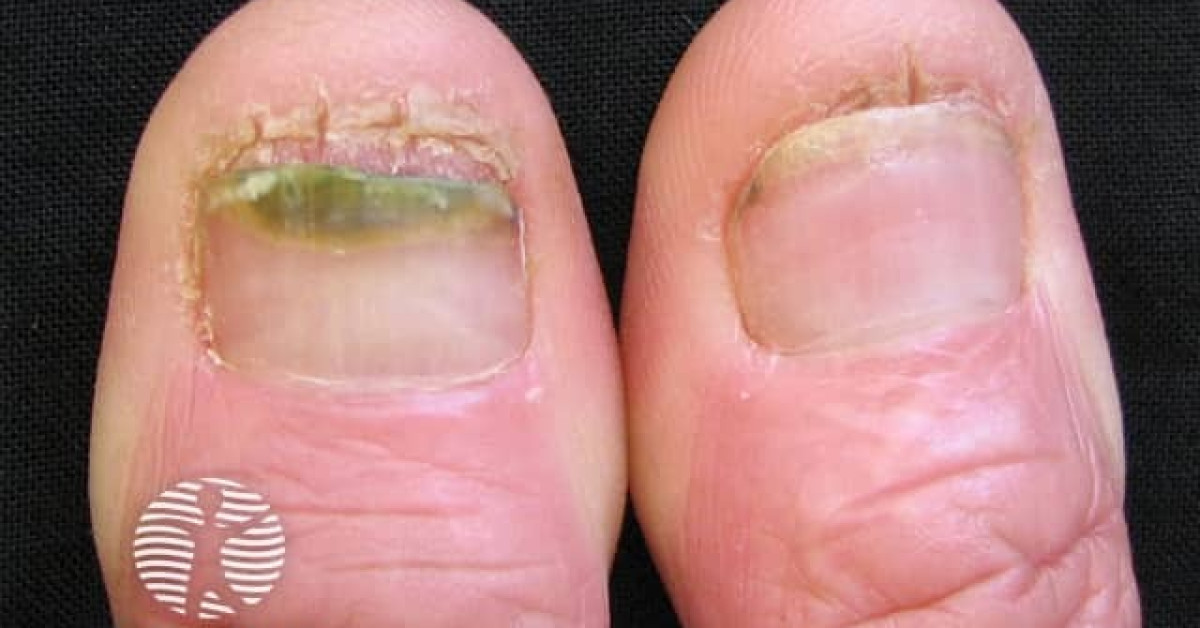 Candida albicans affecting the nails image