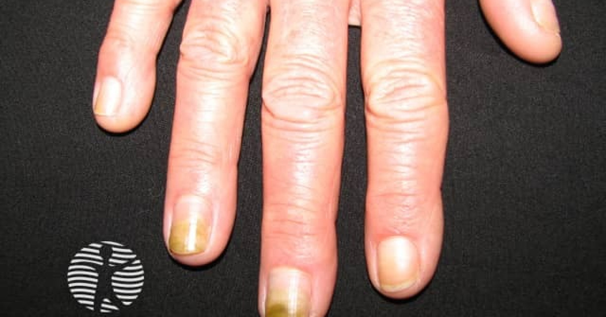 DermNet® - Candida albicans affecting the nails image