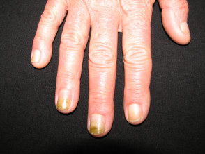 Candida albicans affecting the nails