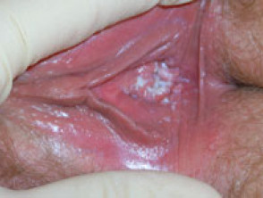 Candidal vulvovaginitis