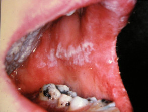 oral thrush after antibiotics
