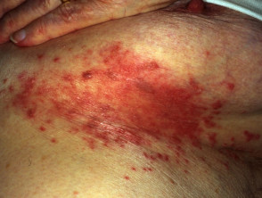 Candidal infection (syn. candidiasis; candidosis; moniliasis)