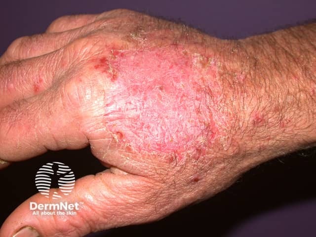 Primary zoophilic dermatophyte infection