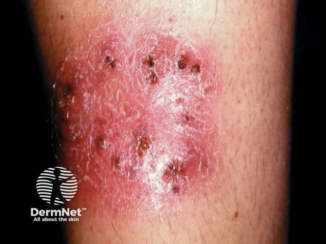 Fungal Skin Infection Images Fungal Skin Infection Images
