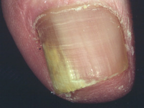 Fungal nail infections, onychomycosis including tinea unguium | DermNet NZ