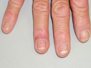 Paronychia: Causes and treatment of an infected nail