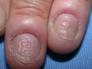 Toenail infection & fingernail infection | Raising Children Network