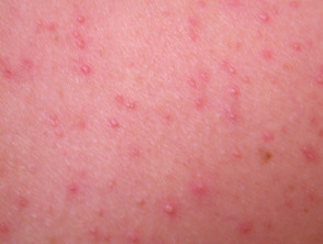 Premium Photo  Rash on the breast of a young woman caused by candida fungus  blisters caused by virus or yeasts