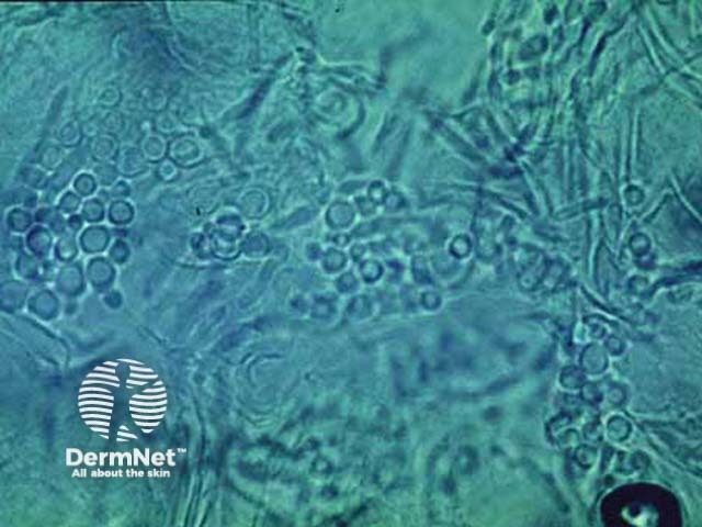 Microscopy of Malassezia furfur