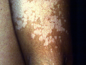 fungus on black skin