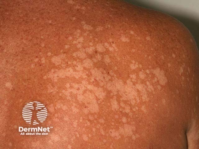 Tinea Versicolor Scalp
