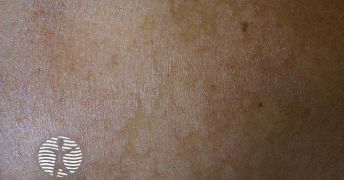 Pityriasis versicolor image