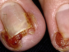 Paronychia (nail fold infection): Causes, Images, treatment, and more —  DermNet