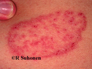 Tinea Corporis Images – Browse 280 Stock Photos, Vectors, and Video