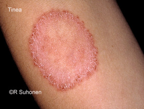 Tinea corporis: ringworm lesion on skin - Stock Image - M270/0169 - Science  Photo Library